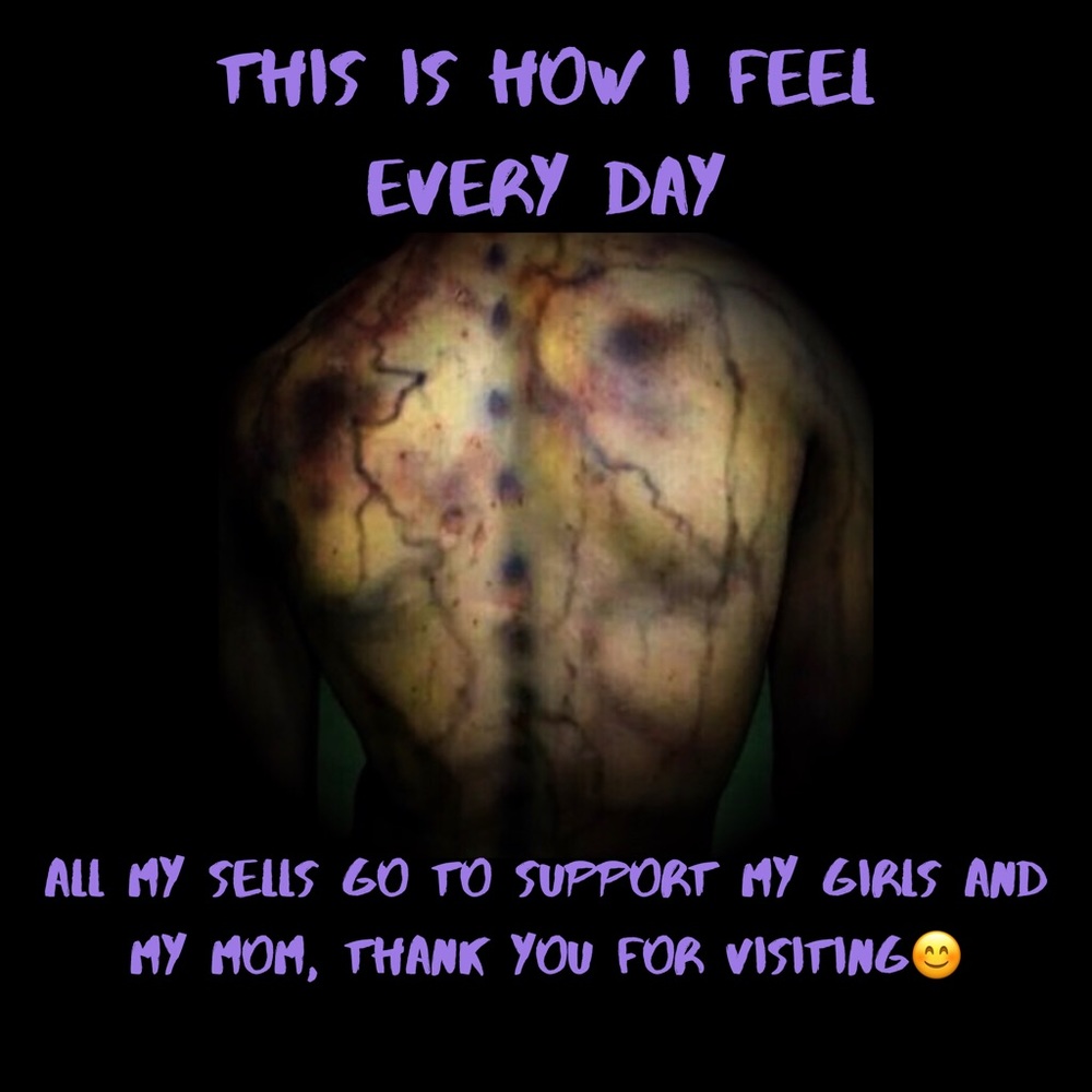 Fibromyalgia is real